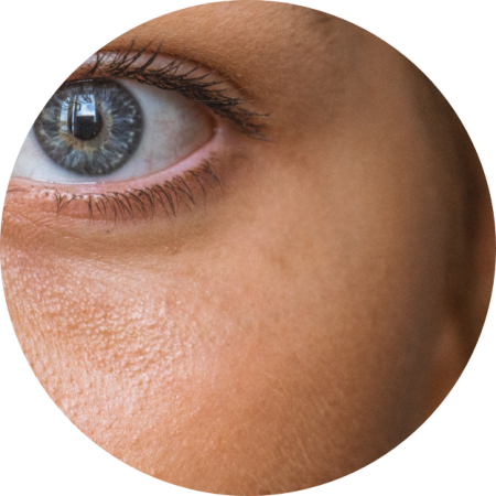 Microneedling With PRF Raleigh